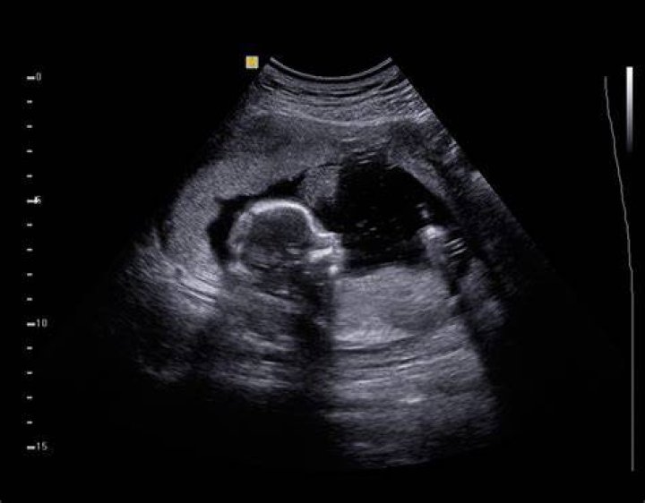Baby Ultrasound This Photo Is Freaking Out The HuffPost Parents